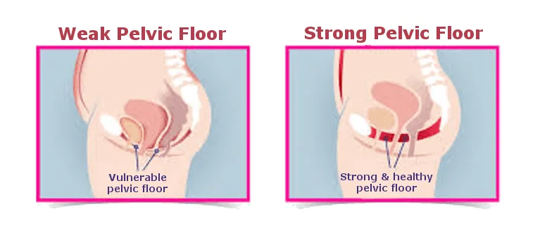 Diagram comparing a weak pelvic floor and a strong pelvic floor